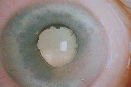 皮質性白內障 皮質性白內障