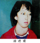 內分泌浸潤性突眼症