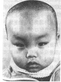 顱縫早閉 顱縫早閉