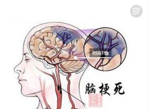 腔隙腦梗塞 腔隙腦梗塞