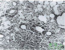 泡沫細胞 泡沫細胞