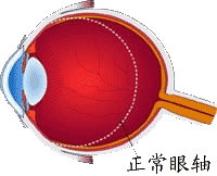 屈光異常 屈光異常