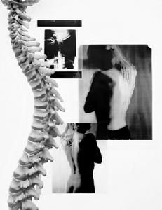 頸椎強直 頸椎強直