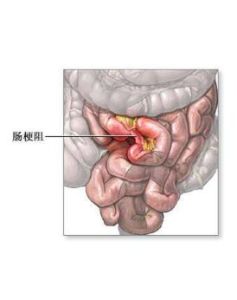 腸梗阻