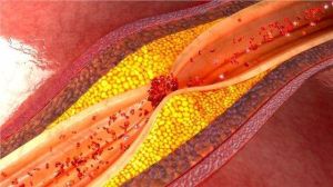 導致動脈阻塞的飽和脂肪酸秘密被揭開