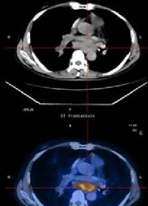細胞癌變 細胞癌變