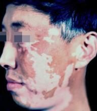 特發性白斑 特發性白斑