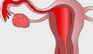 輸卵管功能障礙 輸卵管功能障礙