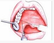 齶前神經 齶前神經