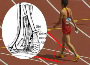 劉翔跟腱受傷