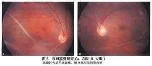 先天性視網膜劈裂症