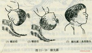 持續性枕橫位難產