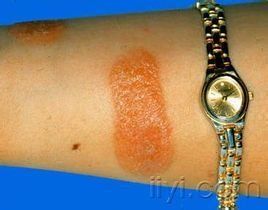 金屬過敏 金屬過敏