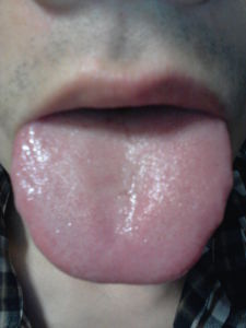 肝胃不和 肝胃不和