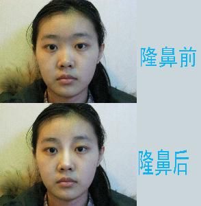 膨體隆鼻 膨體隆鼻