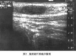 硬纖維瘤超聲影像