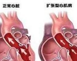 勞力性呼吸困難 勞力性呼吸困難