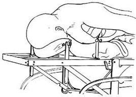 胸椎和腰椎椎板切除減壓術 胸椎和腰椎椎板切除減壓術