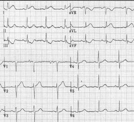 心房紊亂心律 心房紊亂心律