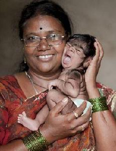 狼人綜合徵 狼人綜合徵