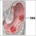 （圖）消化道潰瘍病示例圖