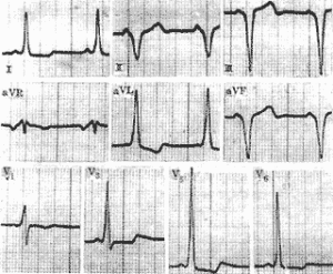 原發性肺動脈高壓