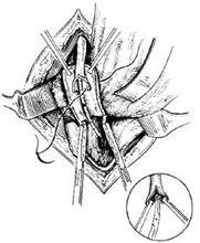 圖10:放入輸尿管導管(示意圖)