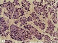 淋巴管肌瘤病 淋巴管肌瘤病