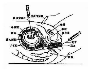 凝血因子遺傳性凝血因子ⅩⅢ缺乏