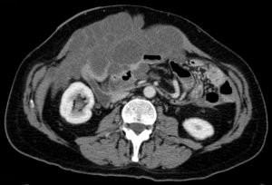 腹膜假黏液瘤 腹膜假黏液瘤