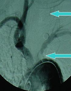 鎖骨下動脈盜血綜合徵