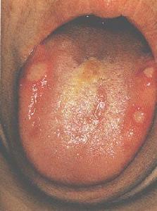 口腔單純皰疹 口腔單純皰疹