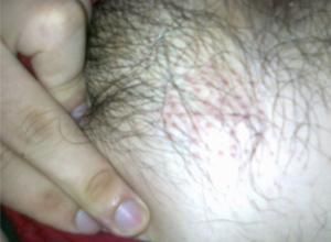 陰毛脫落 陰毛脫落