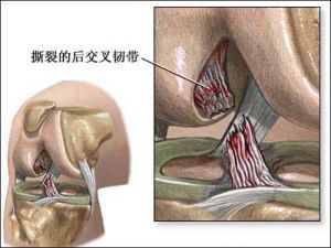 膝關節韌帶損傷—交叉韌帶