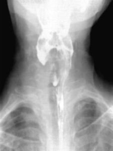 充盈缺損 充盈缺損