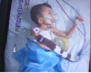 孩子患有布加氏綜合徵