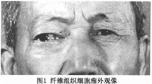 眶內纖維組織細胞瘤