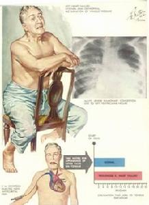 慢性心功能不全