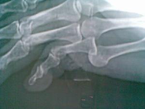 骨關節脫位 骨關節脫位