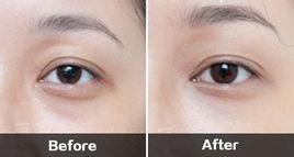 自體脂肪填充眼窩手術 自體脂肪填充眼窩手術