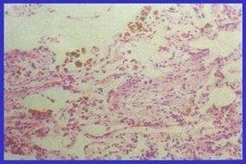 肺含鐵血黃素沉著症 肺含鐵血黃素沉著症