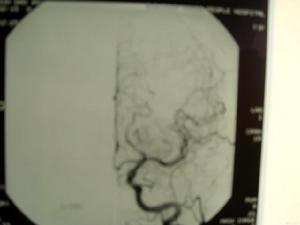 食管受壓性吞咽困難