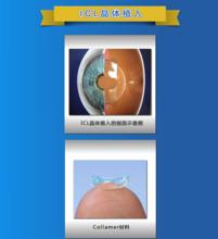 近視雷射矯正術