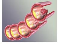 動脈粥樣硬化症