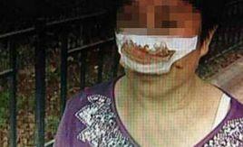 女子鼻子被丈夫咬掉事件 女子鼻子被丈夫咬掉事件