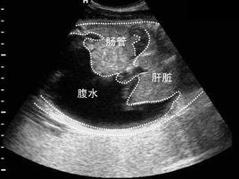 癌性胸腹水 癌性胸腹水