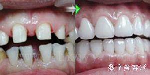 數字美容冠 牙齒稀疏
