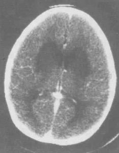 小兒病毒性腦膜炎