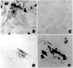 巨細胞病毒感染