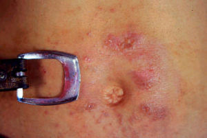 變態反應性皮膚病